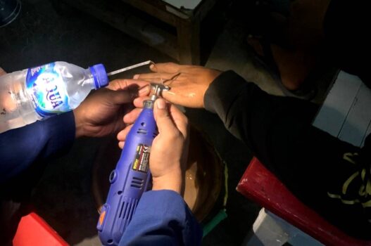Jari Membengkak, Cincin Tak Bisa Lepas