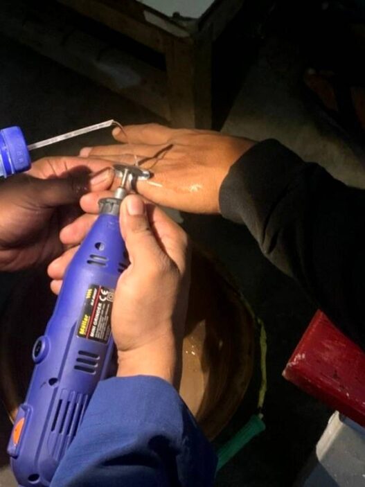Jari Membengkak, Cincin Tak Bisa Lepas