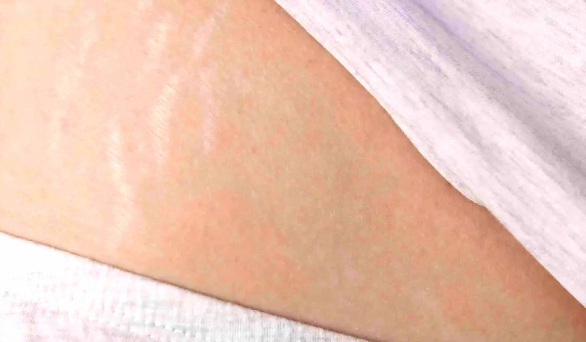 Stretch Mark Mudah Memudar