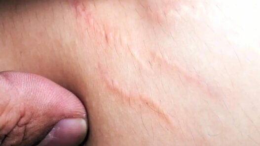 Tips Pudarkan Stretch Marks