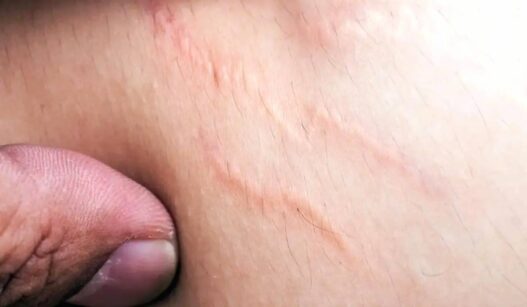 Tips Pudarkan Stretch Marks
