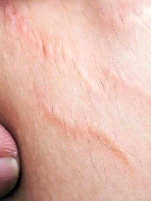 Tips Pudarkan Stretch Marks