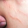 Tips Pudarkan Stretch Marks